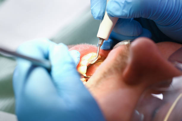 Best Emergency Wisdom Teeth Removal in Kenmar, PA
